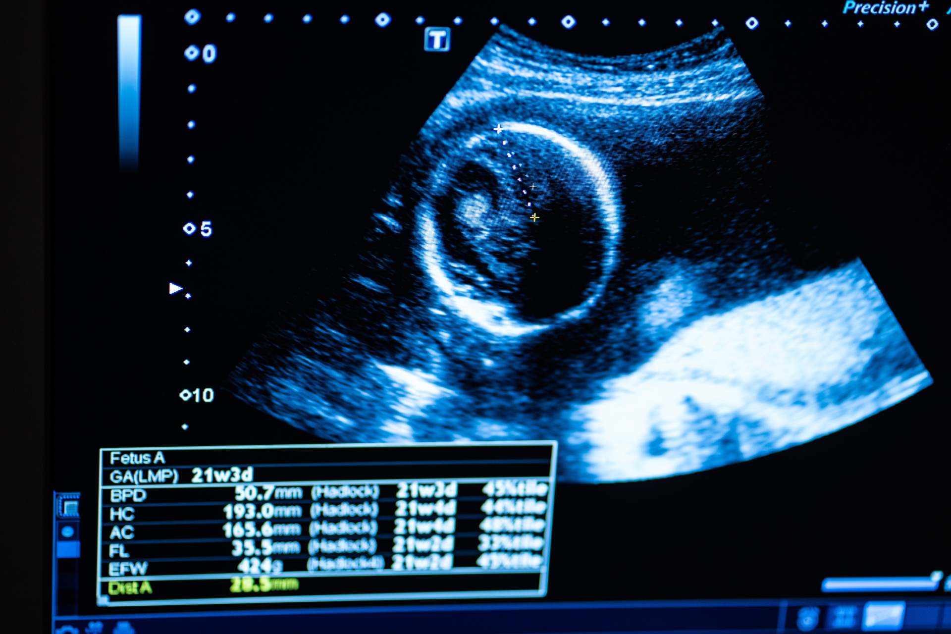 monitor-during-ultrasound-examination-pregnancy-2025-03-10-02-40-22-utc (1)